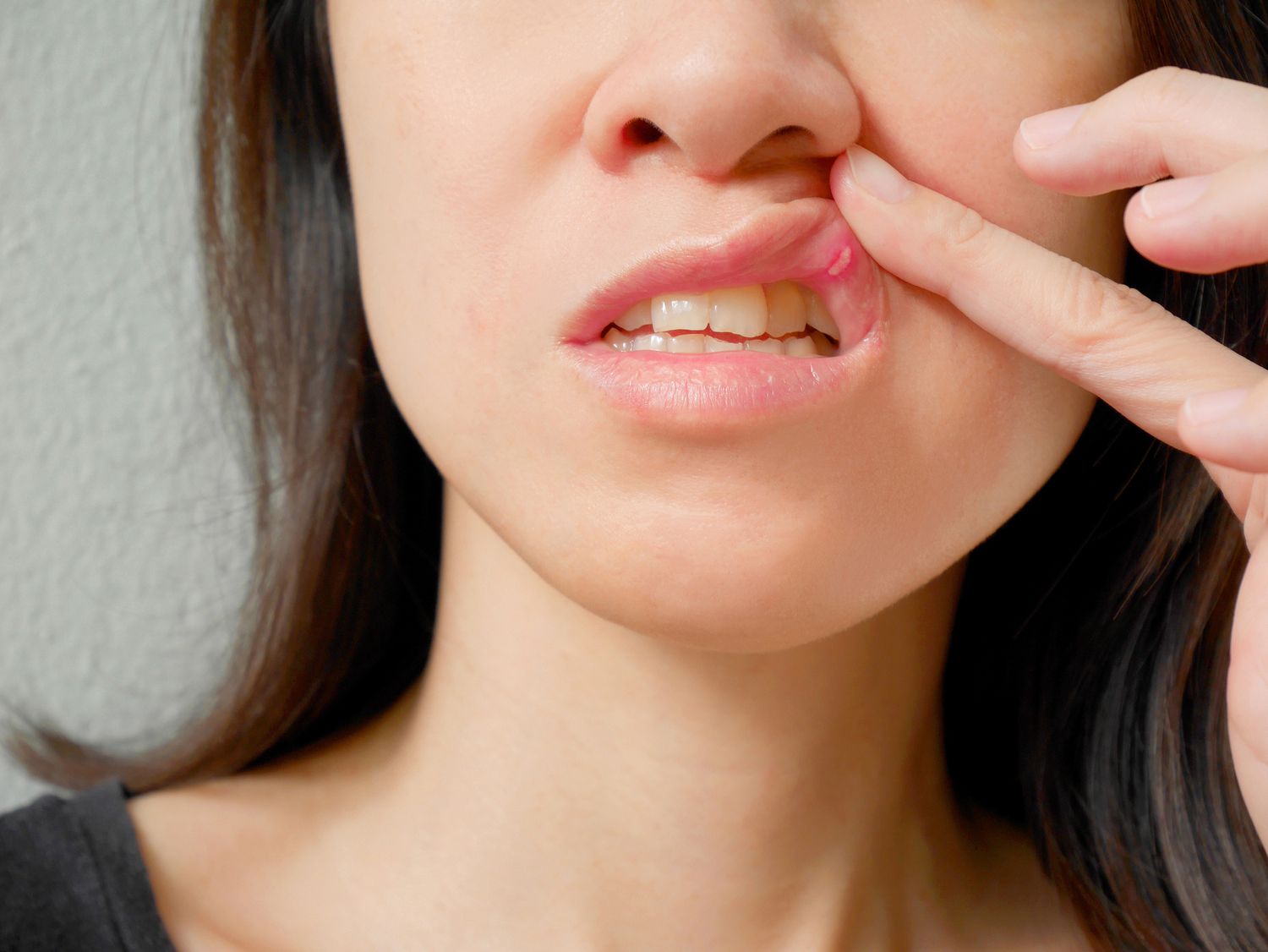 Best veneers teeth in Surat
